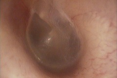 Normal Tympanic Membrane,11, L ear