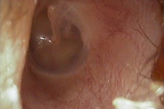 Normal ear canal and tympanic membrane, left ea
