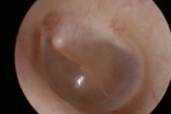 Normal left ear, 25 yr male