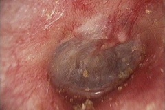 Normal tympanic membrane 10, R ear.
