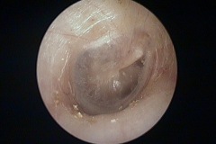 Normal tympanic membrane, R ear