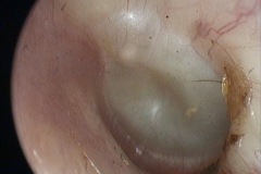 Opaque thick TM, flat tympanogram, no glue, L ear