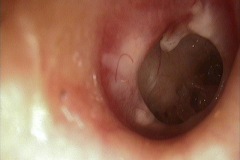 Perforation , large, moist right ear, tympanosclerotic inflammed margins