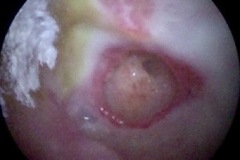 Perforation and myringitis, L ear, Round window niche seen through perforation