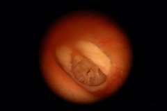 Perforation, inactive and tympanosclerosis