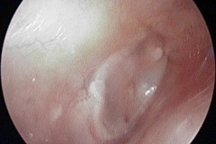 Post op Myringoplasty, 6/12 after surgery, R ear,1