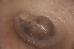 Postersuperior shallow retraction pocket, asymptomatic, left ear