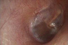 Repaired, grafted tympanic membrane, myringoplasty 10 years ago, right ear
