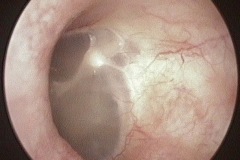 Tympanic membrane, slightly abnormal malleus handle, C HL, ? congenital ossicular abnormality, L ear